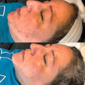 Dr. Pen A11 Ultima Pro Dermapen photo review